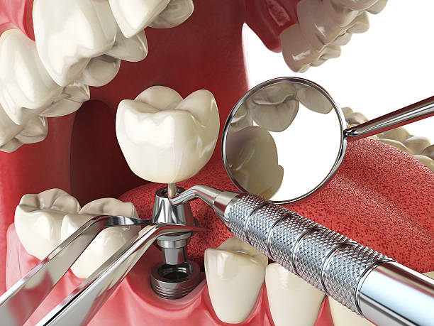 Best Emergency Treatment for Dental Infections or Abscesses in Claymont, DE